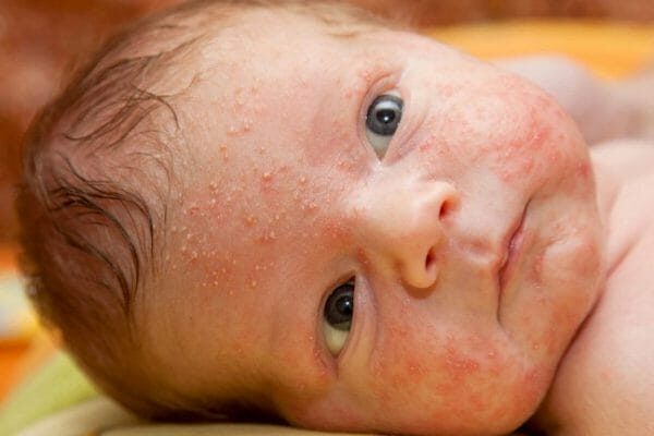 baby-acne-002-ows8x932ddv3bqrna4cwnoqjusvmpouxj8rpb7j2cg